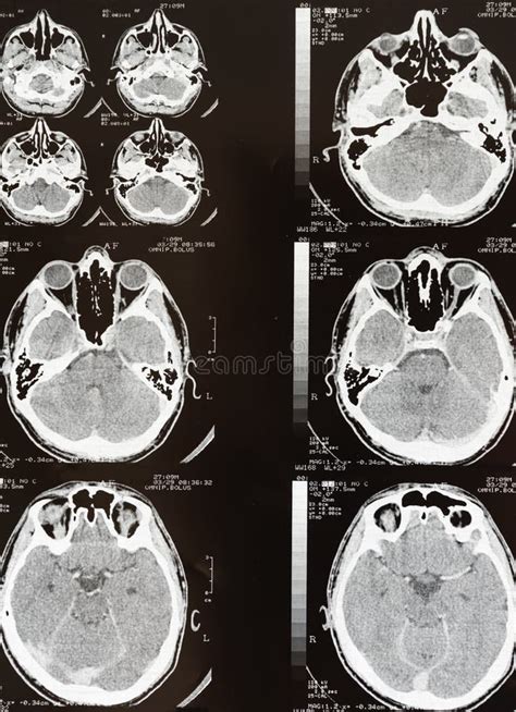 Human Brain Mri Scan Stock Photo Image Of Mind Science 227660202