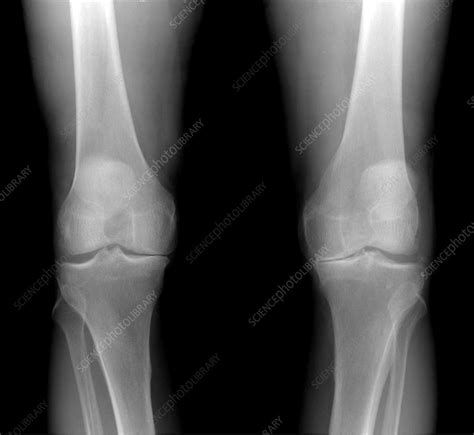 Arthritis Both Knees Stock Image C0034571 Science Photo Library