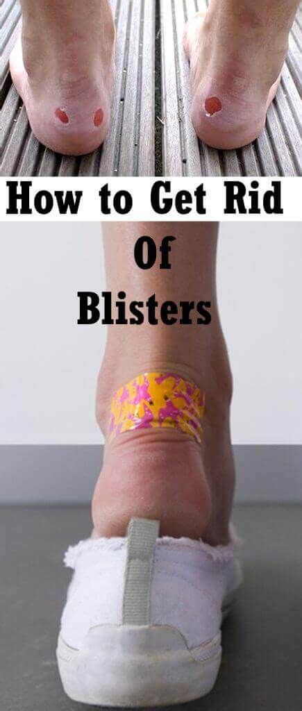 Home Remedies For Blisters Complementary And Alternative Medicine