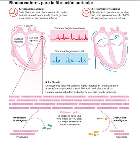 Identifican Biomarcadores Que Predicen El Riesgo De Fibrilación