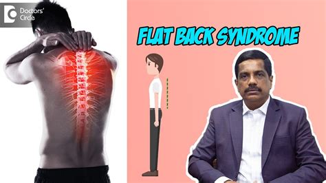 Flat Back Syndrome Straightening Of Spine Back Pain Dr Kodlady