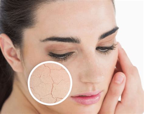 How To Get Rid Of Dry Skin20 Natural Remedies