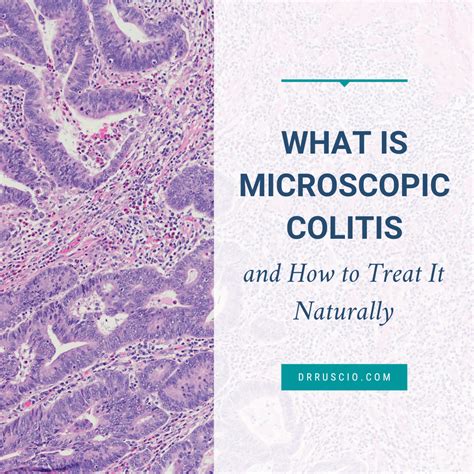 What Is Microscopic Colitis And How To Treat It Naturally Dr Michael