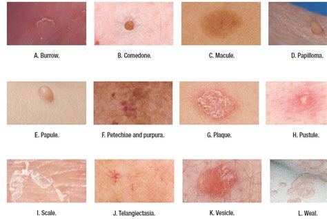 Medical Addicts Terms Used To Describe Skin Lesions Dermatology