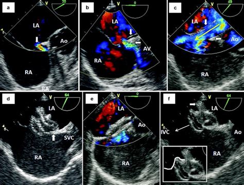 Echocardiography In The Management Of Atrial Septal Defect Asd And