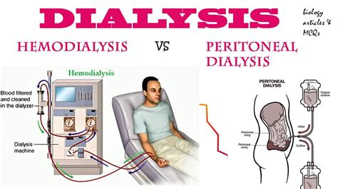 Dialysis Hemodialysis Peritoneal Dialysis Biology Articles And