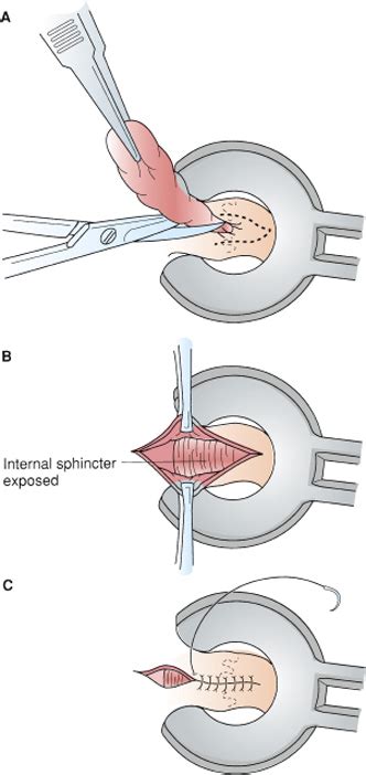 Thrombosed Hemorrhoid Incision And Drainage