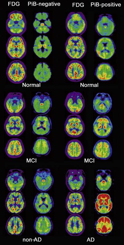 Molecular Neuroimaging In Alzheimers Disease Radiology Key