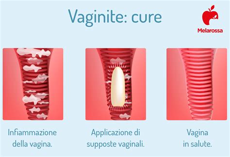 Vaginite Cos Tipi Cause Sintomi E Trattamenti Melarossa