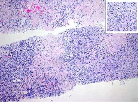 Histopathological Results Of A Core Needle Biopsy Of A Squamous Cell