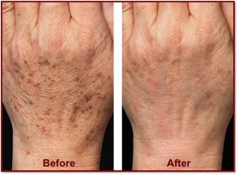 University Dermatology Hand Rejuvenation
