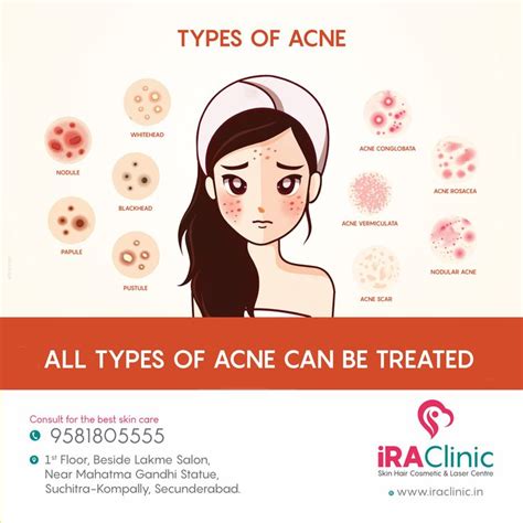Know About All Types Of Acne And Get The Right Solution From Ira Skin