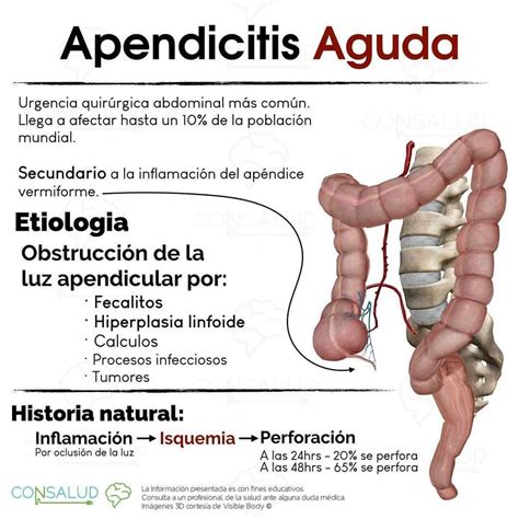 Apendicitis Aguda Gpc Apendicitis Apendicitis Aguda Udocz Kulturaupice The Best Porn Website