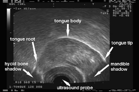 A Midsagittal Ultrasound Image Of The Tongue Prominent White Line
