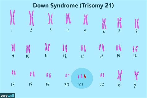 Down Syndrome Overview And More