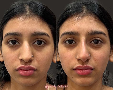 Non Surgical Rhinoplasty Before And After Results
