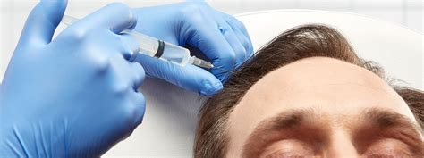 Treatment may help with some types of hair loss. PRP Therapy Orchard Park, NY - Hair Loss Treatment | Dr ...