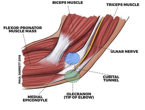 Cubital Tunnel Syndrome Dr Paul Jarrett Orthopaedic Surgeon Perth