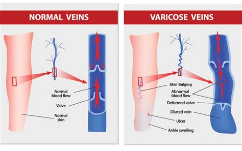 Chronic Venous Insufficiency Treatment And Diagnosis Tx Vein