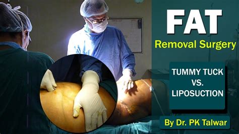 fat removal surgery liposuction vs tummy tuck best fat removal surgery in delhi dr pk