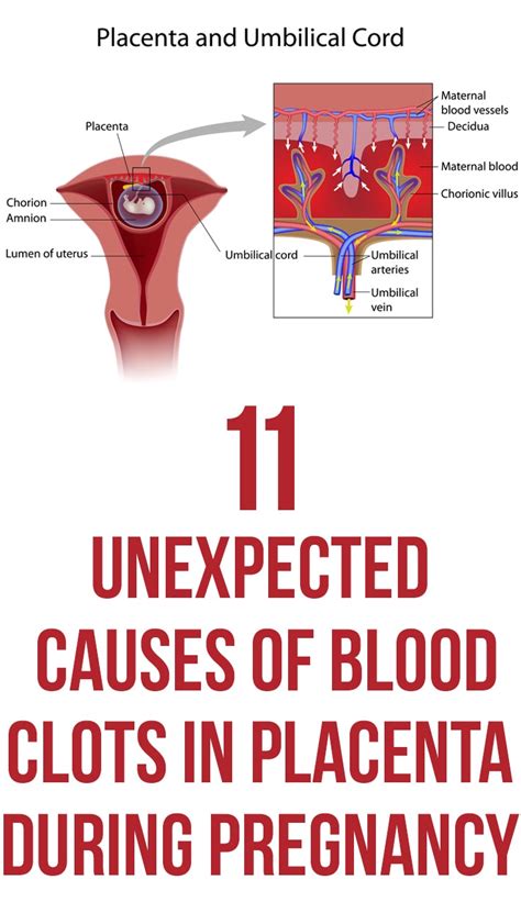 Causes Of Blood Clots In Placenta During Pregnancy