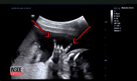 Sonogram Shows Fetus Flashing Rock N Roll Salute