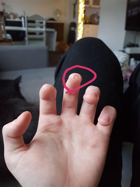 This Bit Of My Half Chopped Off Finger Is Like A Nail Root Or Something
