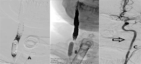A And B Selective Cannulation Of The Right Common Carotid Artery Was