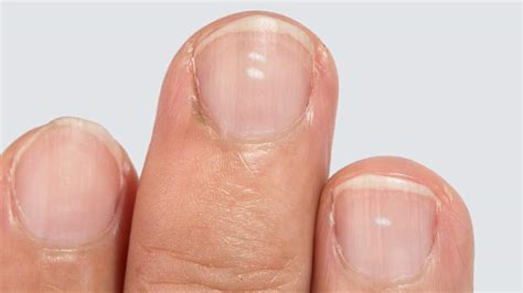 What Causes White Spots In Your Fingernails Design Talk