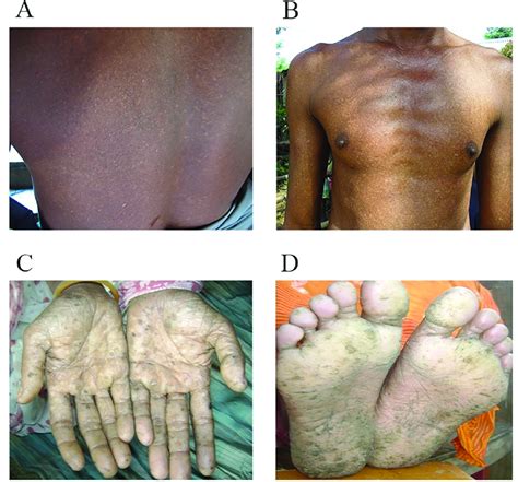 Representative Photographs Of Arsenic Induced Skin Lesions A