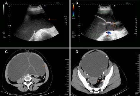 Frontiers Giant Ovarian Cysts Treated By Single Port Laparoscopic Surgery A Case Series