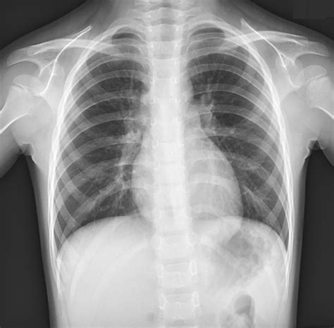 Chest X Ray Of A Year Old Patient Presenting With Respiratory My Xxx Hot Girl