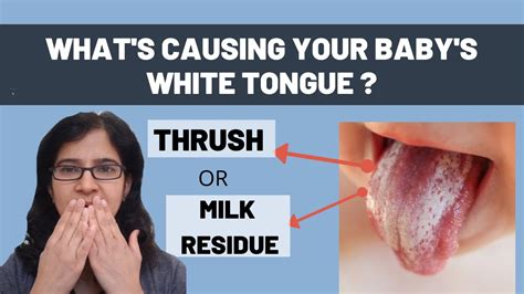 Thrush Vs Milk Tongue How To Tell The Difference