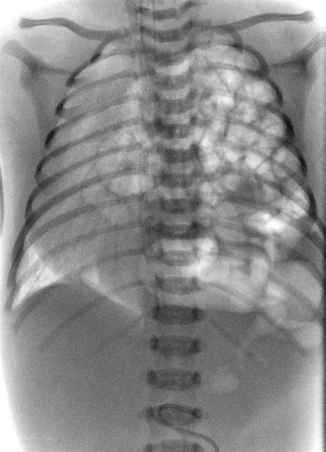 Congenital Diaphragmatic Hernia X Ray Photograph By Du Cane Medical