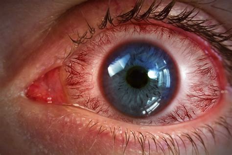 What Is Sjogrens Syndrome Northwest Eye Center Pc
