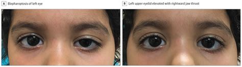 Evaluation And Management Of Unilateral Congenital Ptosis In A Healthy