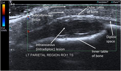 Sonographic Diagnosis Of Intraosseous Epidermoid Cysts Of The Calvarium Holley 2016