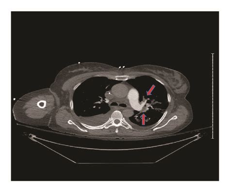 Ct Angiogram Showing Pulmonary Embolism Arrow Download Scientific