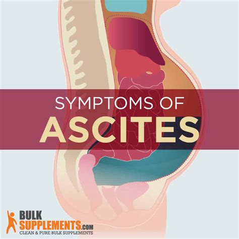 Ascites Symptoms Causes And Treatment