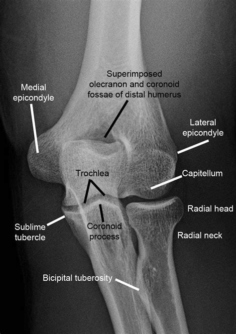 Elbow Joint Anatomy Radiology Mri Protocols Elbow Mri Anatomy