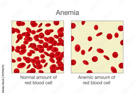 The Difference Of Normal Amount Of Red Blood Cell And Anemia