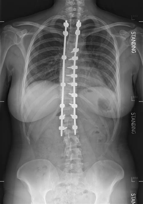 Before And After Spinal Fusion Revision R Scoliosis