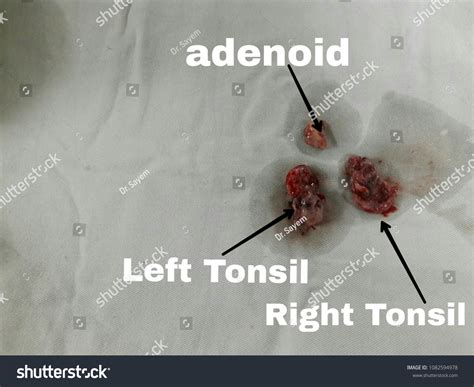 1 Operation Adenotonsillitis Images Stock Photos And Vectors Shutterstock