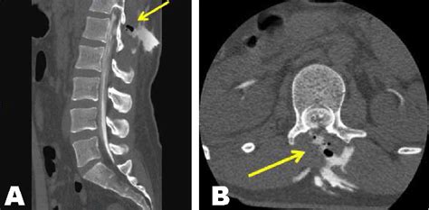 Lumbar Spine Ct Myelogram Lumbar Spine