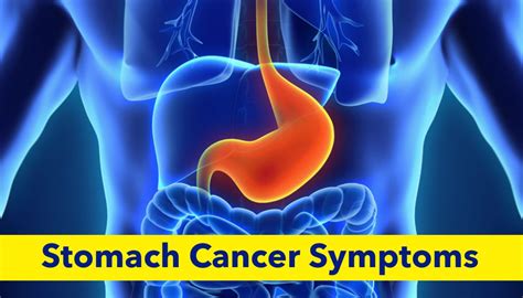 8 Stomach Cancer Signs You Shouldnt Ignore