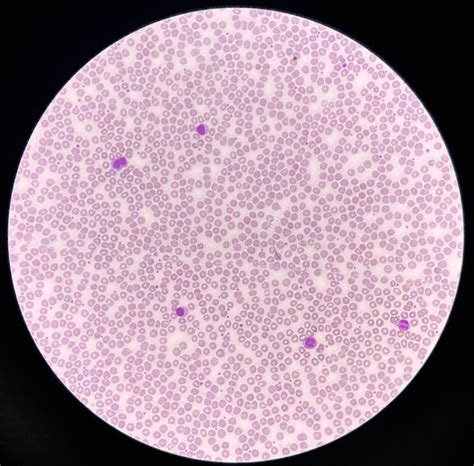 Normochromic And Normocytic Rbc Blood Smear Stock Photo Image Of