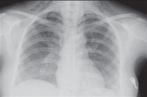 P A Chest X Ray Showing Subcutaneous Emphysema In The Neck Download