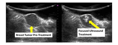 It also can be used to look at a suspicious area that was seen on a mammogram. Price Lab | Focused Ultrasound for Breast Cancer Drug ...
