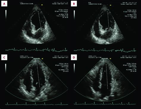 Transthoracic Echocardiogram Apical 4 Chamber View Showing Apical And