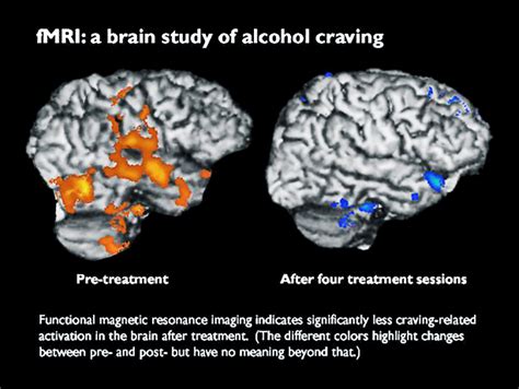 Brain Scans Suggest This Therapy Eases Alcohol Cravings Futurity